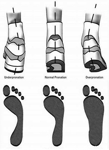 关于“足内翻”“足外翻”的中文释义及鞋型选择 - 综合 - 户外资料网