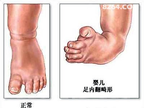 关于足内翻足外翻的中文释义及鞋型选择