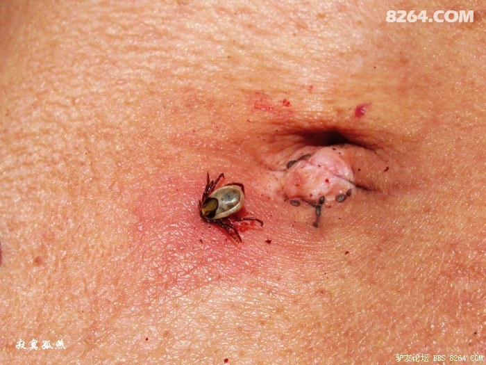 草虱子(即蜱虫,也称草爬子)