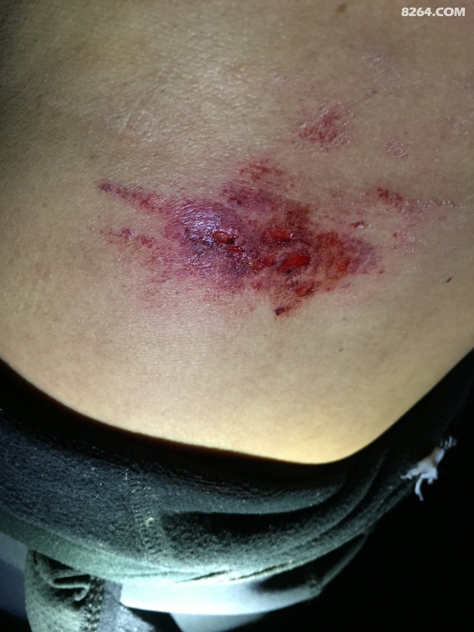 产生麻痹心里,半夜摔车在路边的坑里,损失不小:手表划损,眼镜摔伤